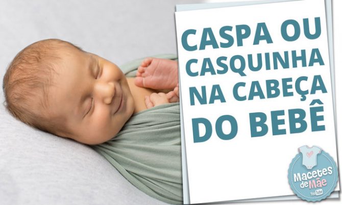 Caspa ou casquinhas na cabeça do bebê